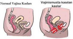 Vajinusmus belirtileri ve tedavisi