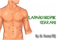 Ürolojide laparoskopik cerrahi