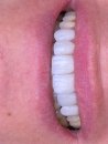 Minimal diş kesimi ve lamine porselen kaplamalar: estetik iyileştirmelerde yenilikçi bir yaklaşım