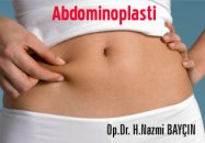 Abdominoplasti