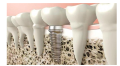 İmplant diş tedavisi nedir?