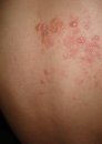 Herpes zoster, zona veya halk dilinde gece yanığı