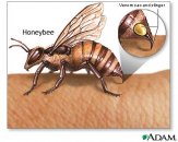 Arı alerjisinde aşı tedavisi