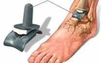 Total ayak bileği protezi