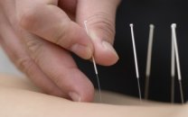 Akupunktur tedavisi nedir?