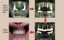 İmplant ''sorular ve cevaplar''