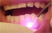 Lazer destekli diş hekimliği 'sorular ve cevaplar