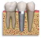 Dental ( dişle ilgili) implantlar