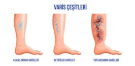 Varis hastalığının komplikasyonları nelerdir??