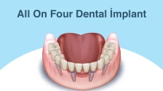 All on four implant sistemleri