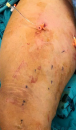 Efficiency of prophylactic ablation of the tributary venous pathways draining around the saphenofemoral junction to decrease the rate of future varicose vein and symptoms occurence