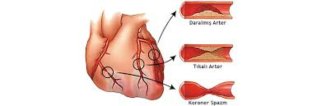Koroner arter hastalığı