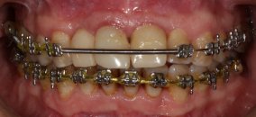 Dişeti hastalığı ve ortodonti