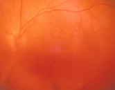 Göz içi kanama (vitreus hemorajisi)