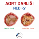 Aort darlığı nedir?
