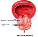 İyi huylu prostat büyümesi (benign prostat hiperplazisi, bph)