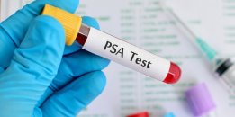 Psa testi nedir ve ne zaman yapılmalıdır?