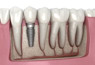 Diş hekimliğinde zirkonyum uygulamaları
