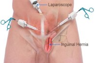 Laparoskopik inguinal herni ameliyatı: minimal invaziv cerrahi teknikle sağlığınıza kavuşmak