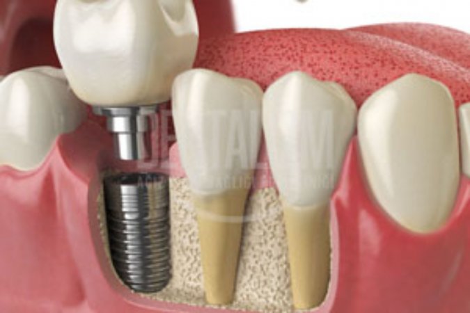 Diş implantı yaptırmak için yaş kısıtlaması var mı?