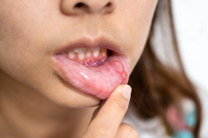 Aft nasıl geçer, afta ne iyi gelir? aft neden olur? 8 soruda aftla ilgili merak edilenler