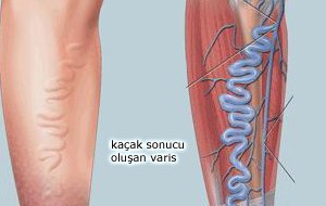 Varis tedavisinde kompleks bosaltıcı fizyoterapi