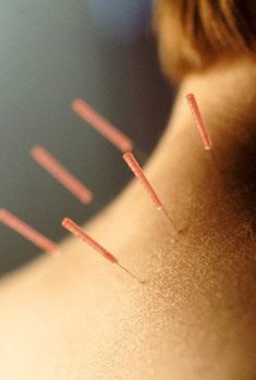 Akupunktur ile bel ve boyun ağrıları tedavisi
