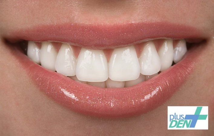 Diş beyazlatma işlemi için en iyi yöntem nedir?