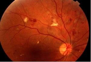 Şeker hastalığı gözü nasıl etkiler? (diabetik retinopati)