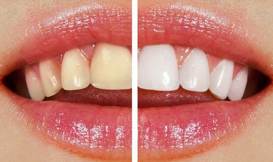 Diş beyazlatmanın (bleaching) ömrü ne kadardır ?
