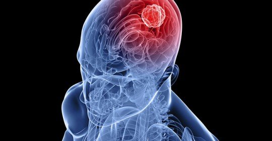Beyin tümörleri kimlerde daha çok görülür?