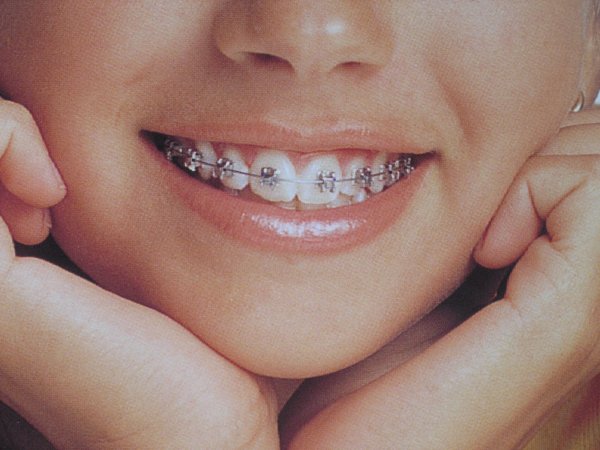 Çocuklarda görülen 'çarpık diş' sorununa dikkat