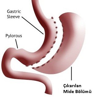 Sleeve gastrektomi (tüp mide)
