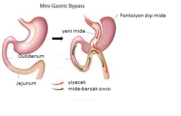 Laparoskopik gastrik by pass (mide by pass’ı)