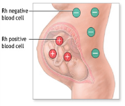 Rh negatif kadınların gebelikleri