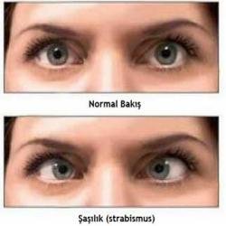 Şaşılık