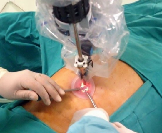 Robotik ve laparoskopik cerrahi (minimal invaziv cerrahi)