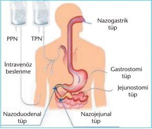 Perkütan endoskopik gastrostomi