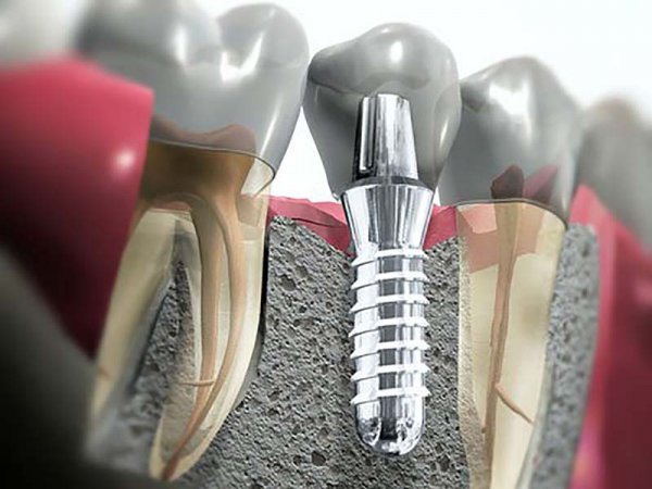 Diş implantı ( dental implant)