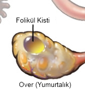 Yumurtalık (over) kistleri,
