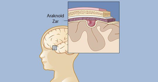 Araknoid kist nedir? nasıl teşhis edilir?