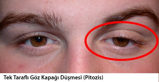 Tek taraflı göz kapağı düşmesi (pitozis)