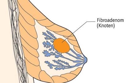 Fibroadenomlar