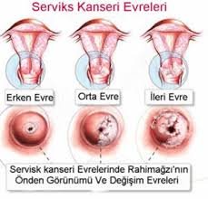 Serviks kanseri, tanısı, tedavisi, aşı ile korunması nasıldır?