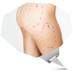 Estetik yağ alma operasyonu | liposuction