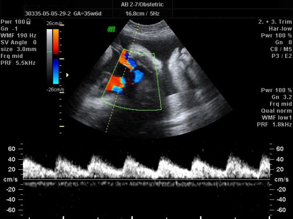Doppler ultrasonografi nedir?