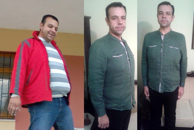 Diyabet hastalığına  cerrahi çözüm