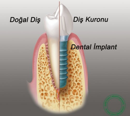 Diş implantları her yaşta uygulanabilir mi?