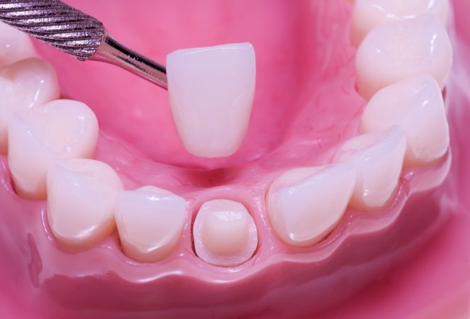 Kaybolan diş ağrılarının gizemi