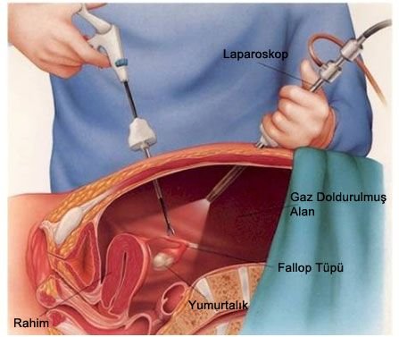 Laparoskopi nedir? laparoskopik uygulamalar nelerdir?